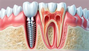 prix des implants dentaires