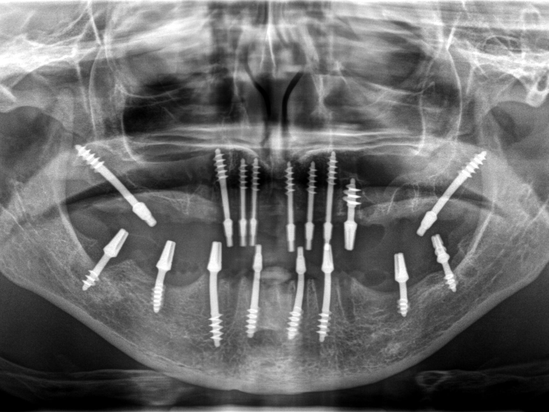 Prothèse dentaire immédiate après extraction