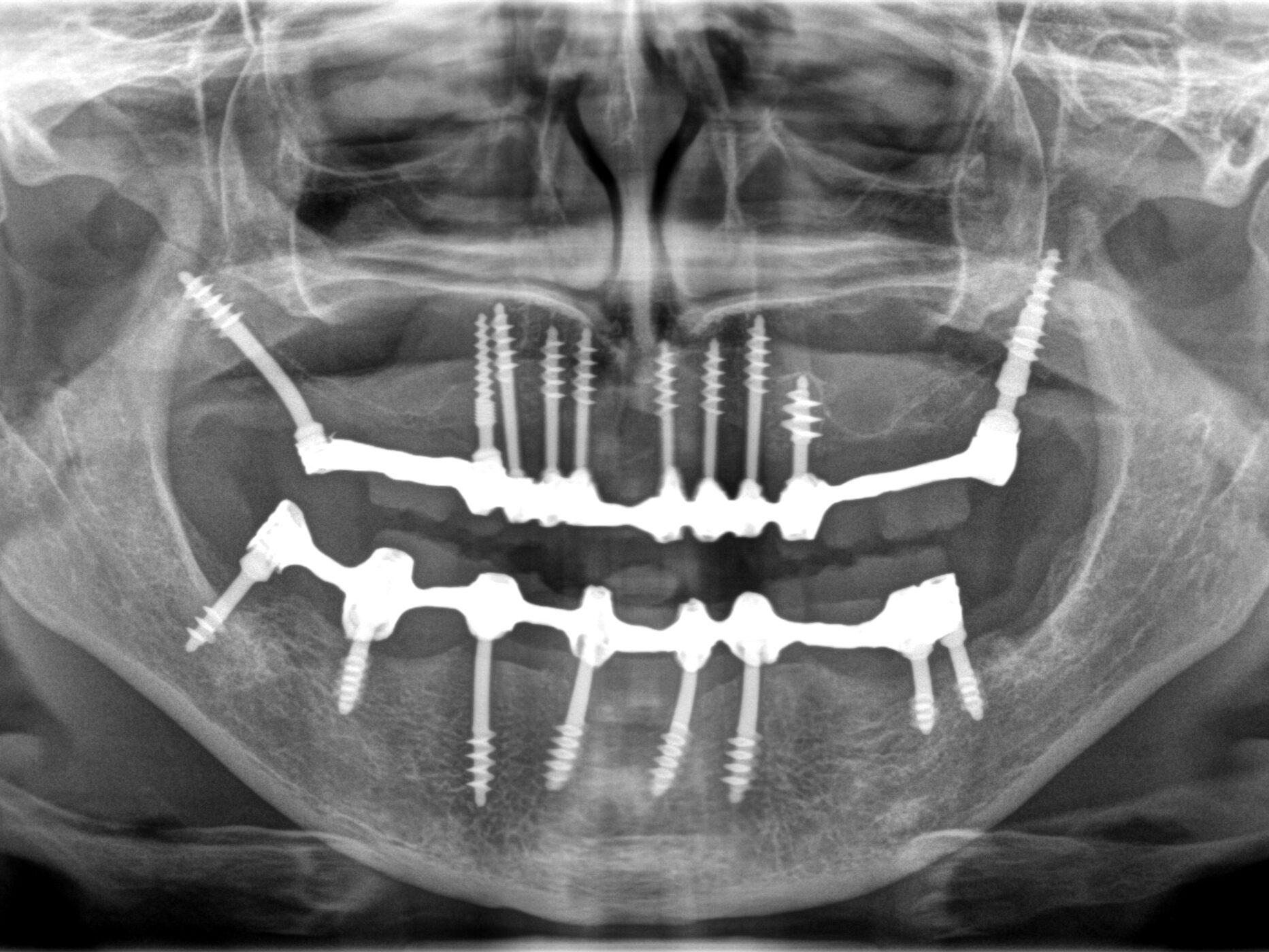 Prothèse dentaire immédiate après extraction