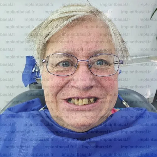 témoignage implant basal