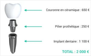 Prix implant dentaire​