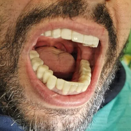 implant dentaire turquie avant