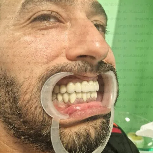 implant basal après