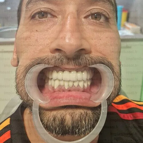 implant basal après