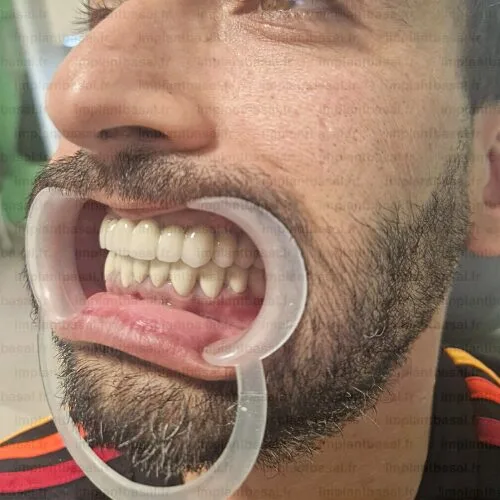 implant basal après