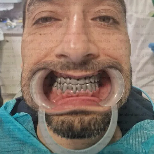 prothese dentaire cadcam