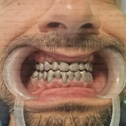 prothese dentaire cadcam