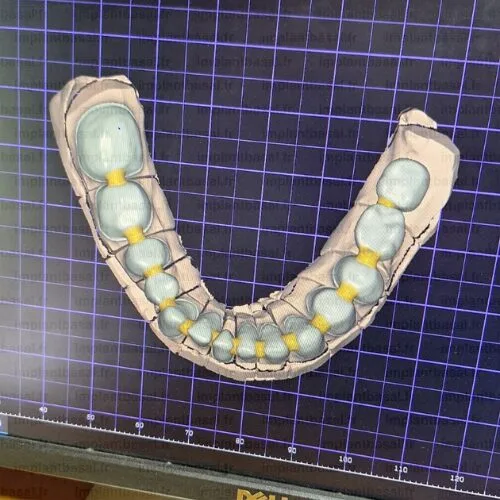 prothese dentaire cadcam