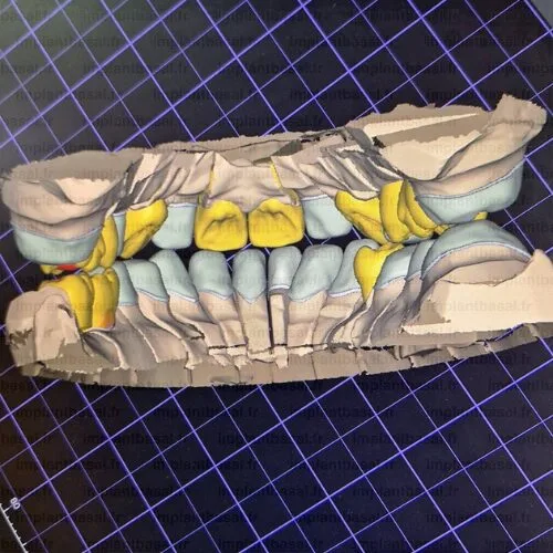 prothese dentaire cadcam