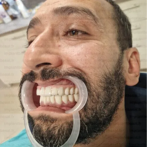 implant dentaire turquie avant