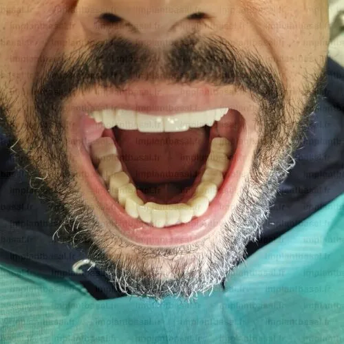 implant dentaire turquie avant