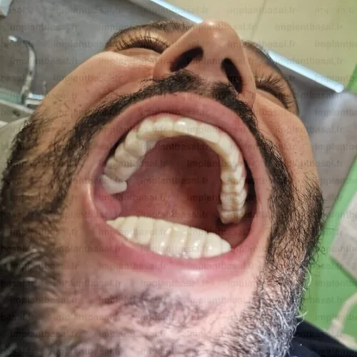 implant dentaire turquie avant