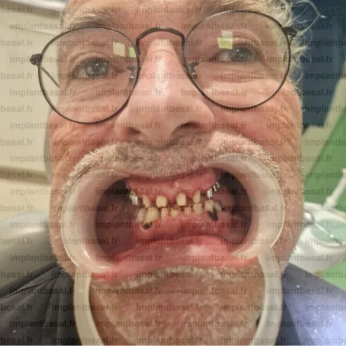 État initial des dents du patient Fabien avant la pose d'implants basaux