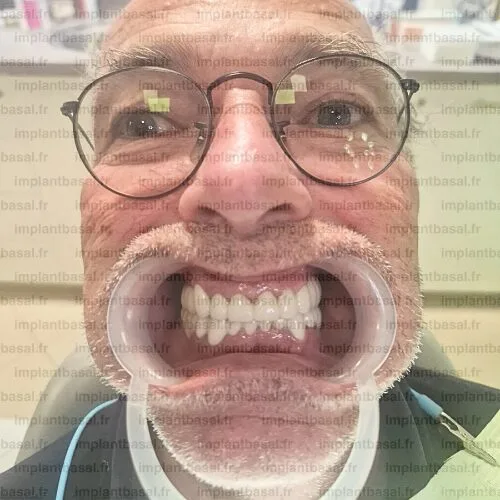 Implant basal apres