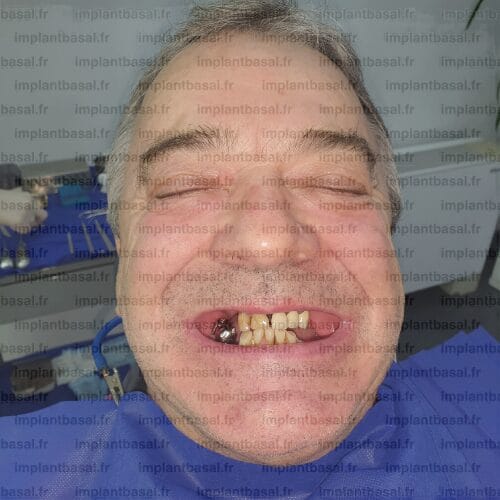 sans greffe osseuse
