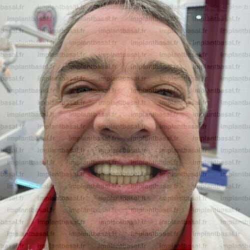 témoignage andre implant sans greffe osseuse